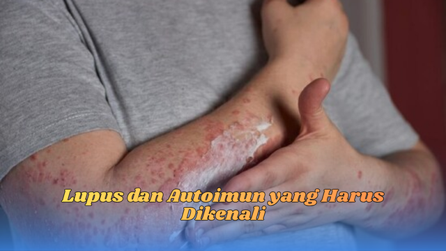 lupus dan autoimun