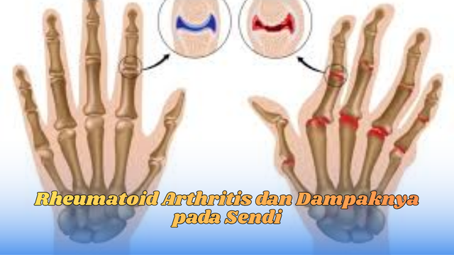 rheumatoid arthritis